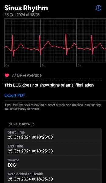 Apple Watch ECG Graph